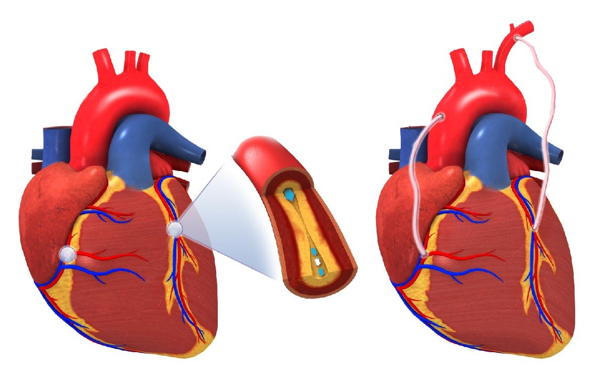 Heart Bypass Surgery
