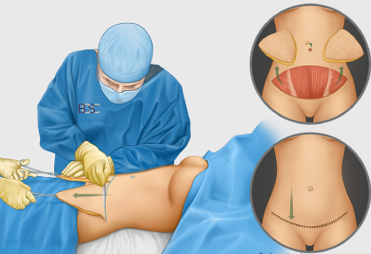 Abdominoplasty (Tummy Tuck)