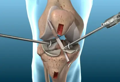 ACL & PCL Reconstruction Surgery