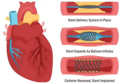 Angioplasty / Stenting