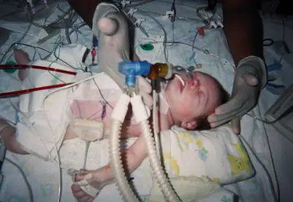 Arterial Switch Surgery (Arterial Switch Operation)