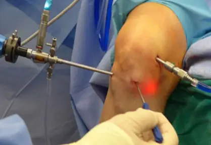 Arthroscopy
