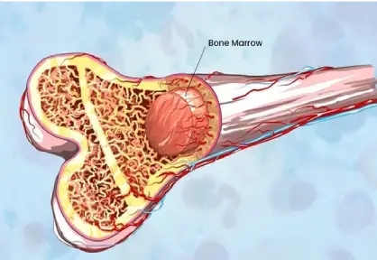 Bone Marrow Transplant