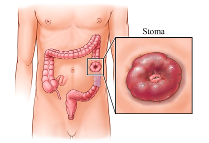Bowel Resection and Anastomosis
