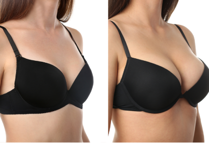 Breast Augmentation