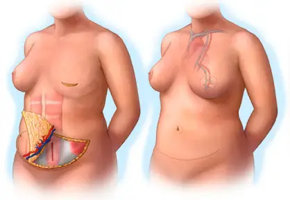 Breast Cancer Treatment