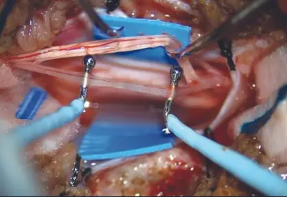 Cerebral Palsy Surgery