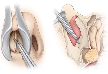 Chondrosarcoma Treatment