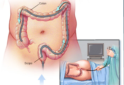 Colonoscopy