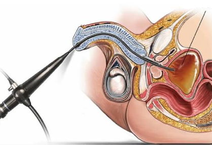Cystoscopy