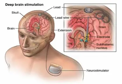 Deep Brain Stimulation (DBS) Surgery