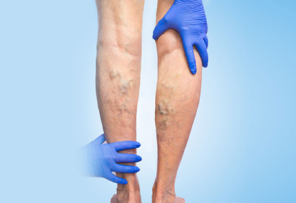 Deep Vein Thrombosis (DVT) Treatment