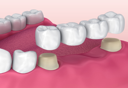 Dental Bridgework