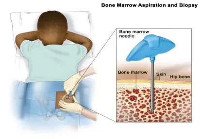 Ewing Sarcoma Treatment