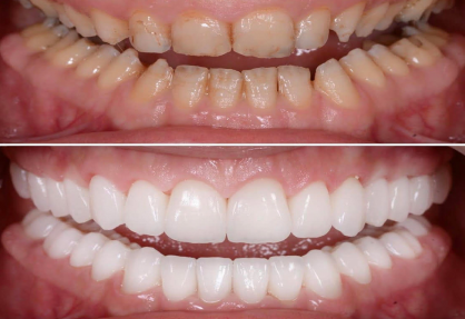 Full Mouth Rehabilitation