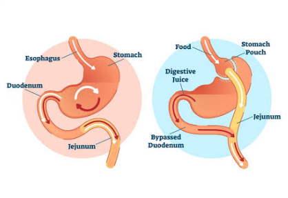 Gastric Bypass