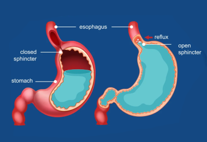 GERD Surgery (Laparoscopic Fundoplication)