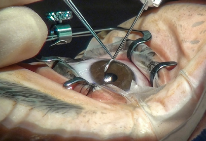 Glaucoma Surgery