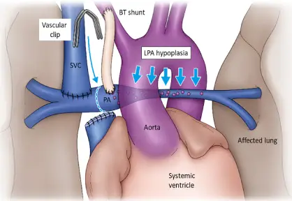 Glenn Shunt (Bidirectional Glenn Procedure)