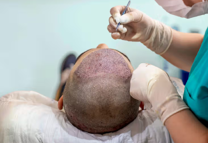 Hair Transplant Surgery