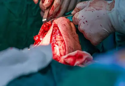 Head & Neck Cancer Surgery