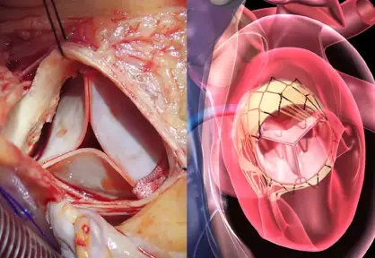 Heart Valve Replacement