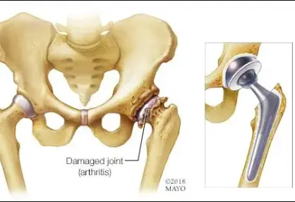 Hip Replacement Surgery