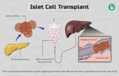 Pancreas or Islet Cell Transplant
