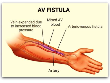 AV Fistula