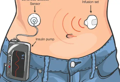 Insulin Pump Therapy