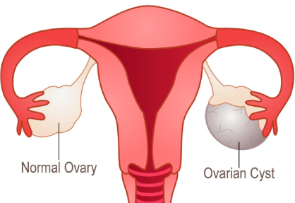 Ovarian Cyst Removal