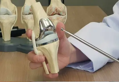 Knee Replacement Surgery