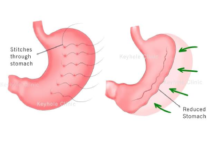 Laparoscopic Gastroplasty (Gastric Plication)