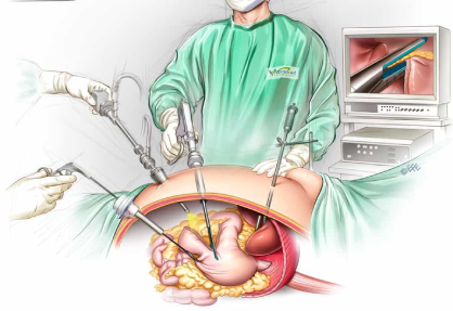Laparoscopic Sleeve Gastrectomy