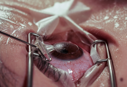 LASIK Surgery