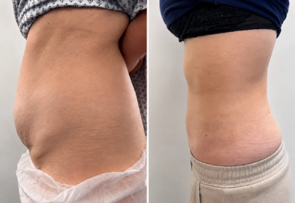 Liposuction