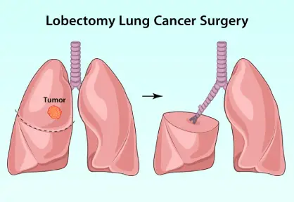 Lung Cancer Treatment / Lobectomy