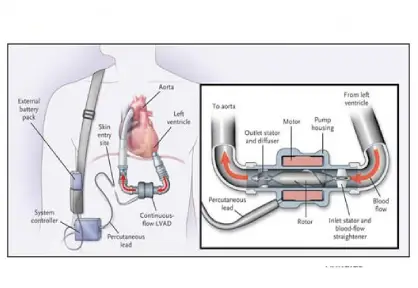 LVAD Implantation