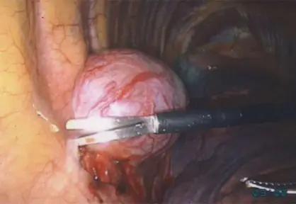 Mediastinal Disease Surgery