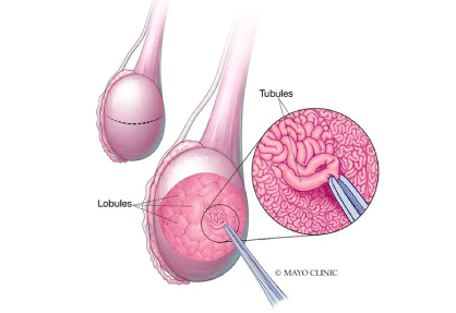 Micro-TESE Surgery