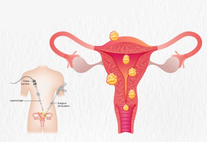 Myomectomy