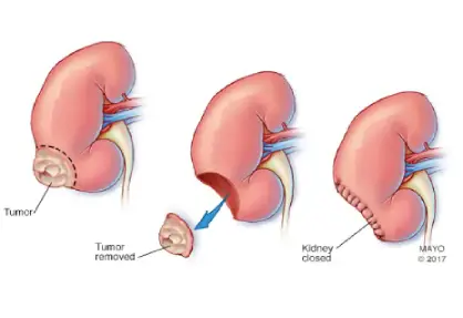 Nephrectomy (Kidney Removal Surgery)
