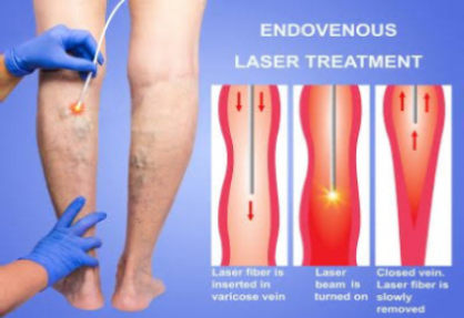 Endovenous Ablation
