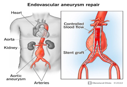 Endovascular Aneurysm Repair