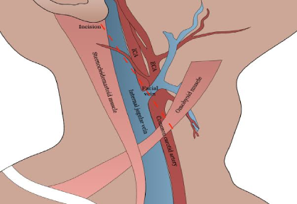 Carotid Endarterectomy