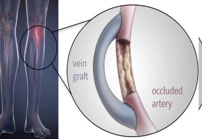 Vascular Bypass Surgery