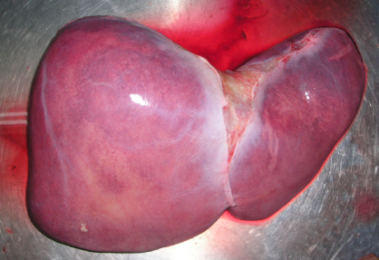Liver Transplant