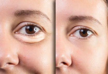 Oculoplasty