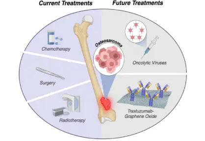 Osteosarcoma Treatment