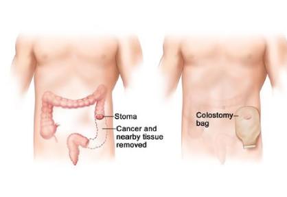 Ostomy Creation